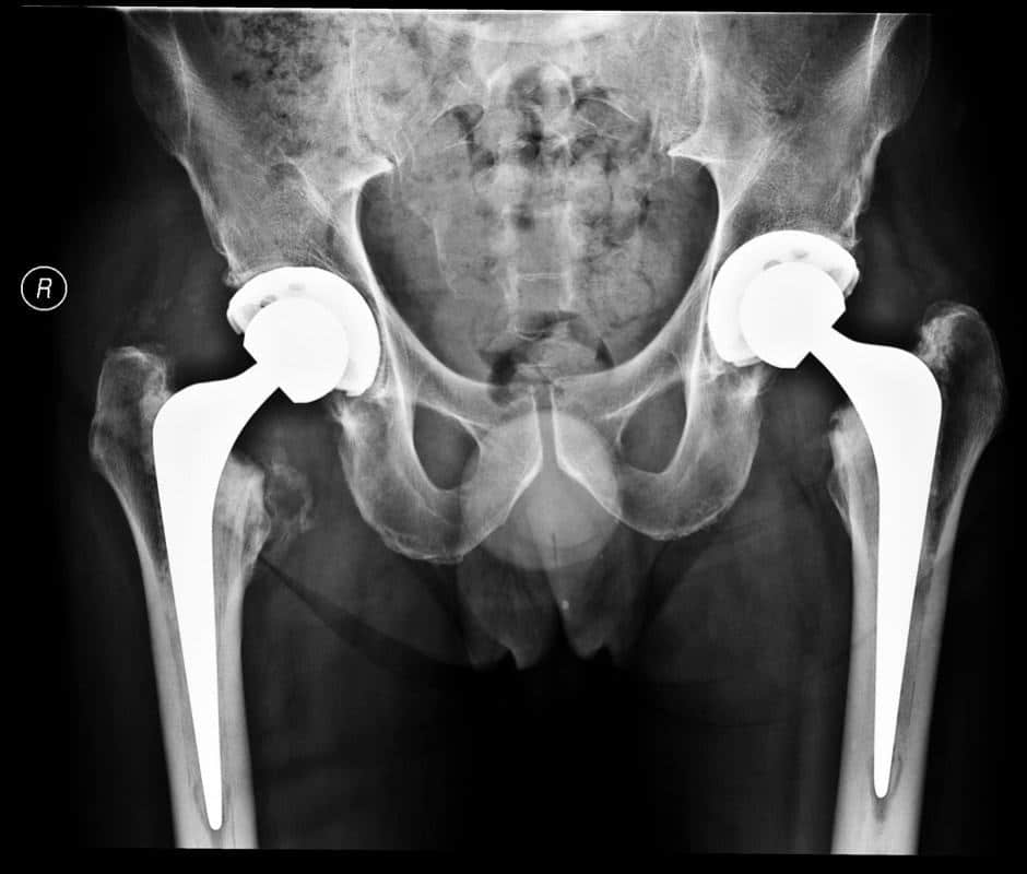 Hip Replacement Surgery Mark Edmondson Consultant Orthopaedic Surgeon