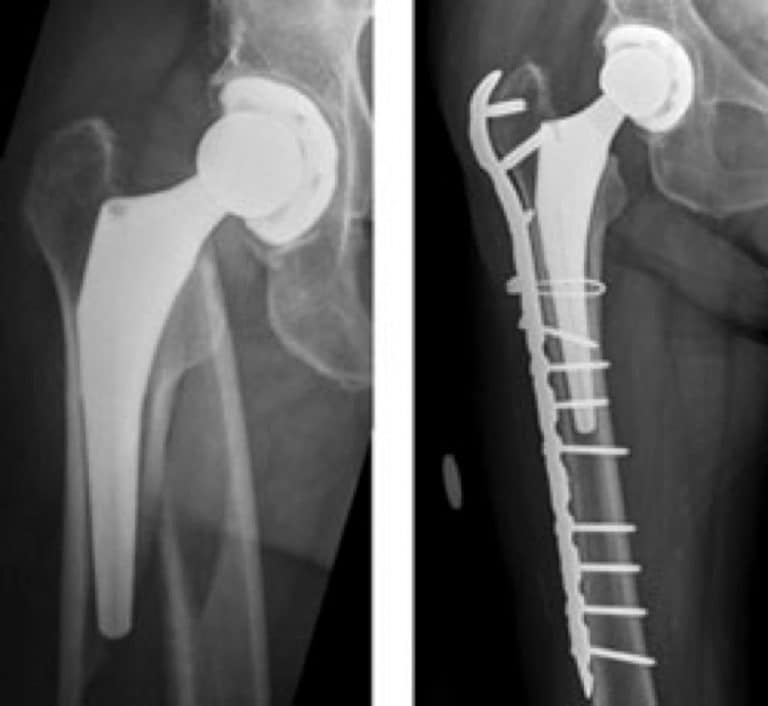Тазобедренный перелом операция. Перипротезный перелом бедренной кости. Перелом бедра после эндопротезирования тазобедренного сустава. Перипротезный перелом бедренной кости пластины. Перипротезный перелом бедренной кости остеосинтез.