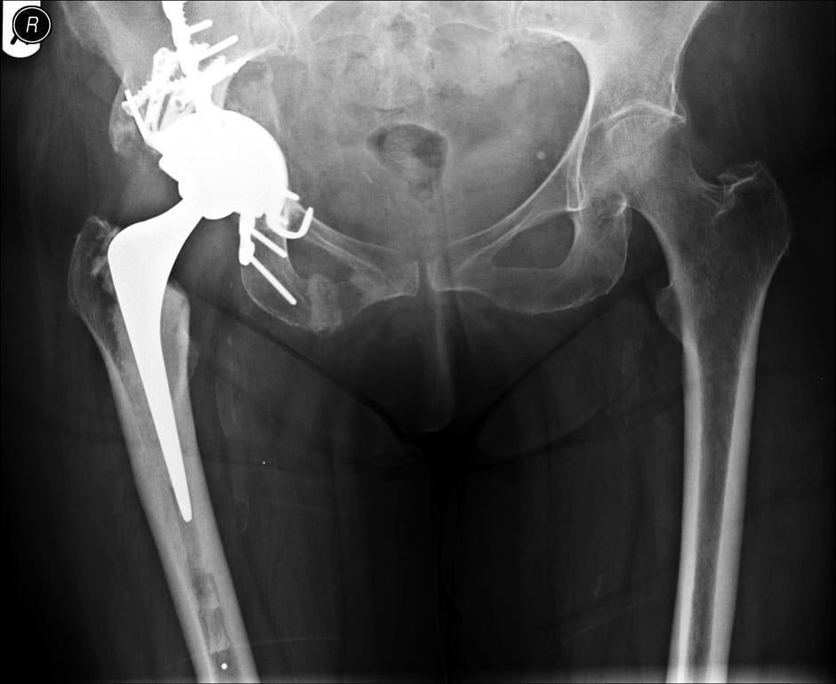 Revision Hip Surgery Mark Edmondson Consultant Orthopaedic Surgeon